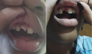 Imagem ilustrativa da imagem Aluna é espancada e perde dente dentro de colégio em São Gonçalo