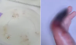 Imagem ilustrativa da imagem Garçom picado por aranha venenosa terá dedo amputado