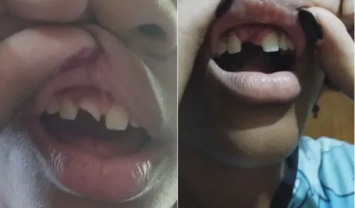 A menina precisou passar por uma cirurgia para retirar pedaços do dente que ainda estavam na gengiva