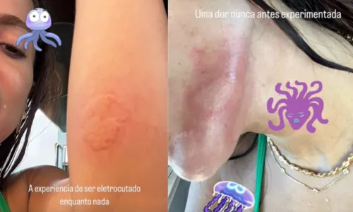 Anitta ficou com queimaduras no rosto e em um dos braços