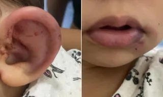 Imagem ilustrativa da imagem 'Luta não acabou', diz mãe de bebê que saiu de creche ferida