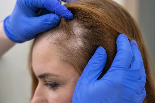 A alopecia pode ter origens variadas