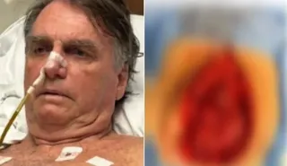 Imagem ilustrativa da imagem Bolsonaro publica imagem de cirurgia abdominal com detalhes