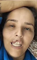 Imagem ilustrativa da imagem Cachorro arranca pedaço da boca de tutora e é morto depois