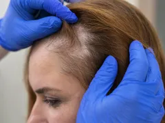 Alopecia: quando a queda de cabelo se torna um sinal de alerta