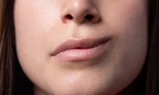 Imagem ilustrativa da imagem Paralisia facial: saiba causas, sintomas e tratamento