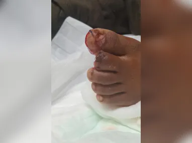 Imagem ilustrativa da imagem Criança perde parte do dedo em escada rolante de shopping em Niterói