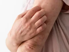 Lúpus: remédios obrigatórios nos planos de saúde