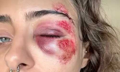 A jovem ficou com o rosto bastante machucado