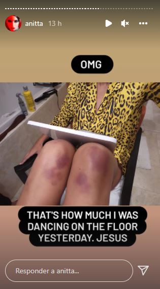 A cantora dançou tanto, que ficou com roxos no joelho.