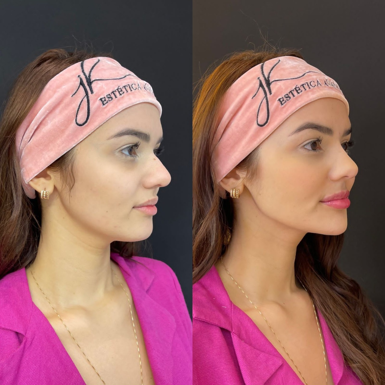 Eslô preencheu a boca, as maçãs do rosto, o queixo e realizou uma rinomodelação