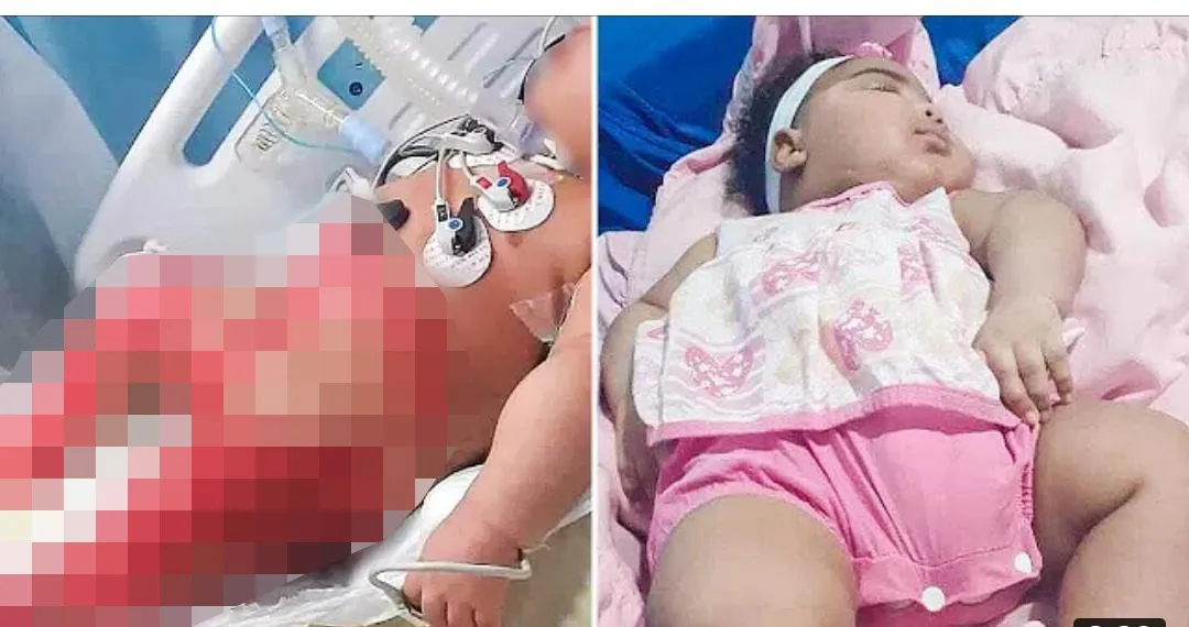 Bebê foi queimada no hospital