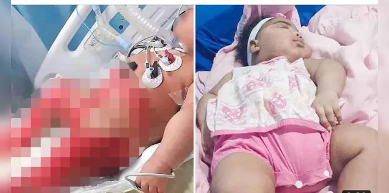 Bebê foi queimada no hospital