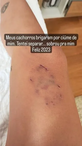 Anitta mostra mordidas e os cachorros que brigaram