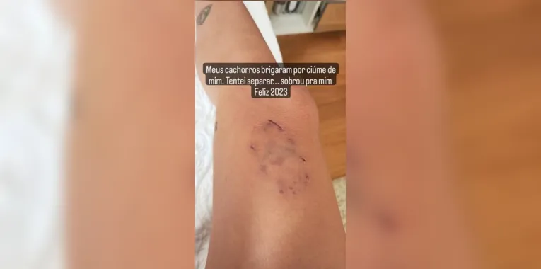 Anitta mostra mordidas e os cachorros que brigaram
