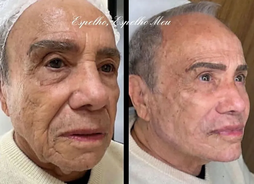 Ator de 91 anos se torna a pessoa mais velha a fazer harmonização facial