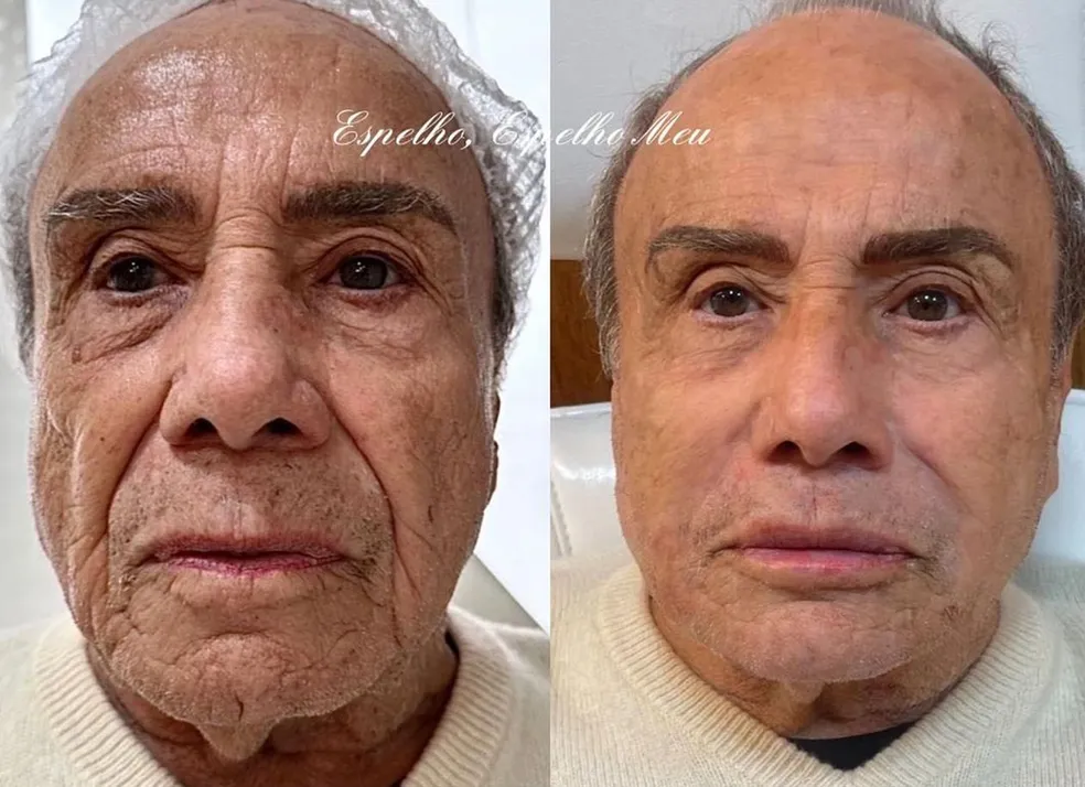 Ator de 91 anos se torna a pessoa mais velha a fazer harmonização facial