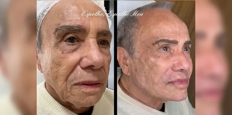 Ator de 91 anos se torna a pessoa mais velha a fazer harmonização facial