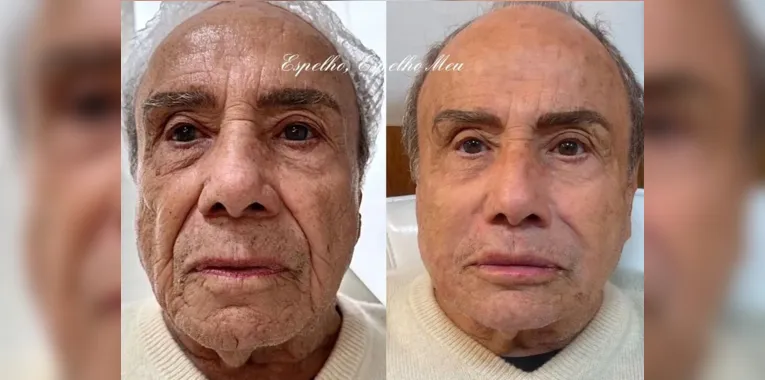 Ator de 91 anos se torna a pessoa mais velha a fazer harmonização facial