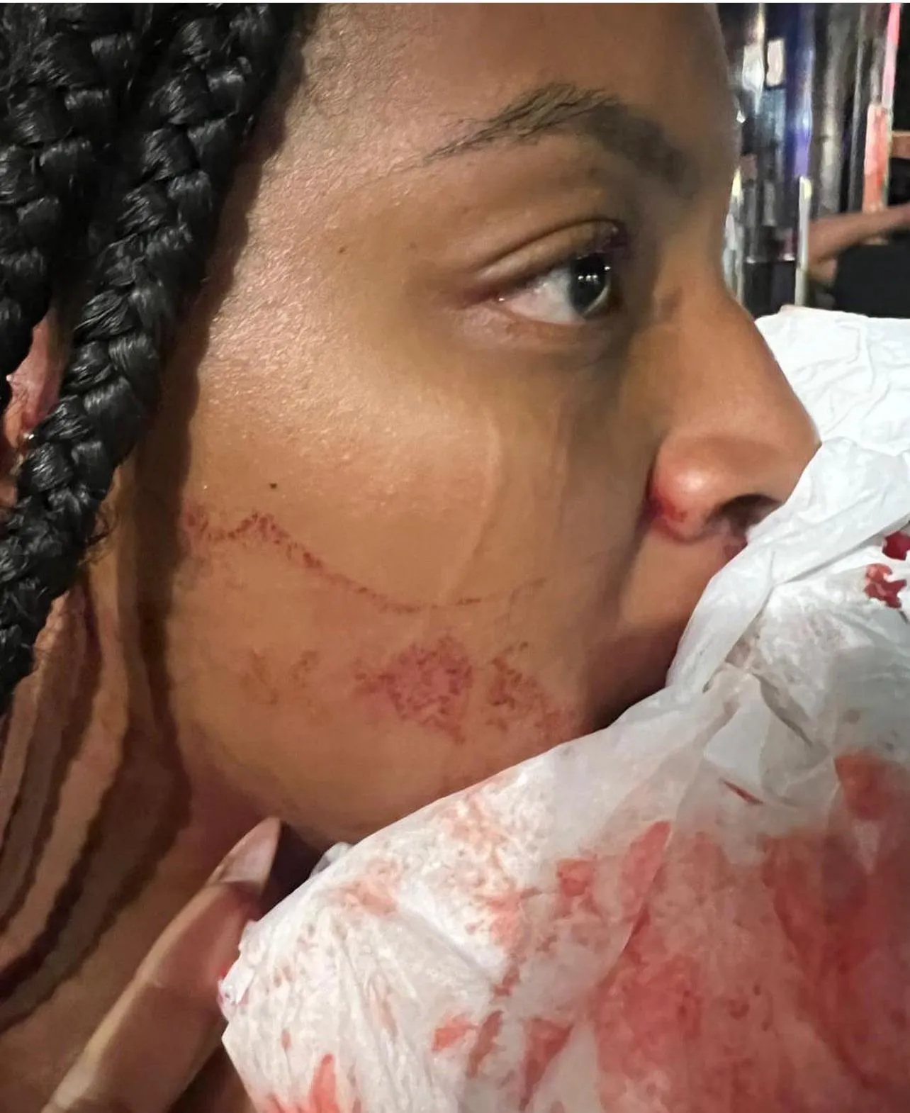 Alessandra Francisco de Souza atingida por um soco, levando 12 pontos na boca