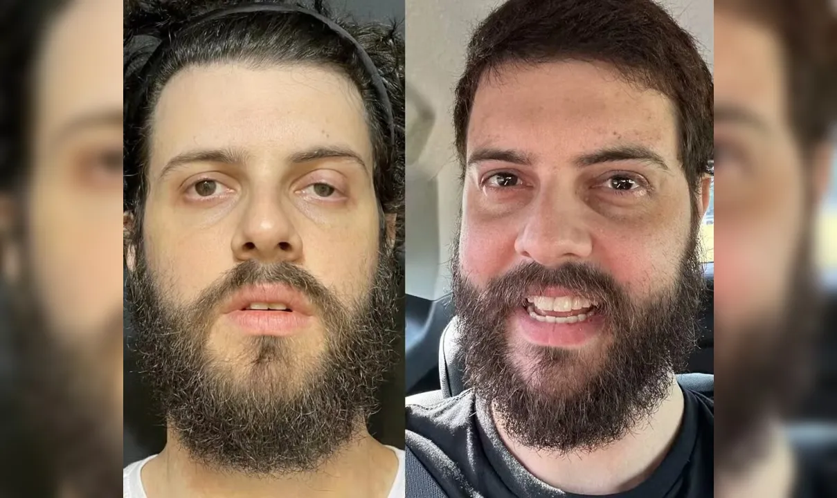 Antes e depois de Diogo Defante após a cirurgia no olho esquerdo