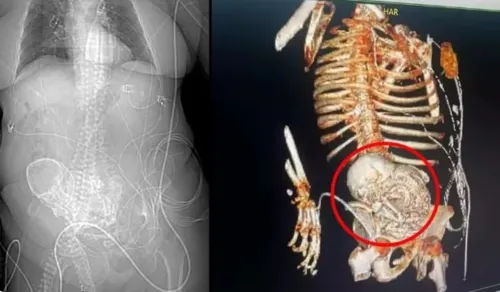 Feto calcificado estava no corpo da idosa há 56 anos