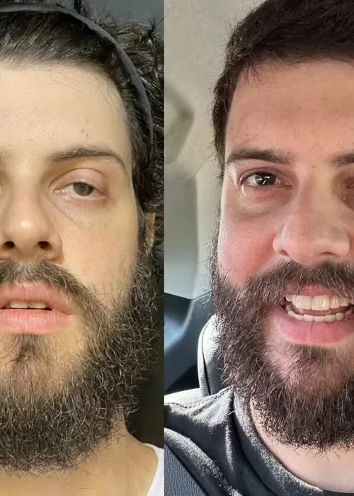 Antes e depois de Diogo Defante após a cirurgia no olho esquerdo