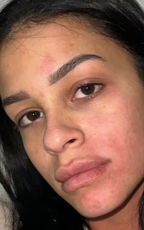 Jovem postou foto dos hematomas