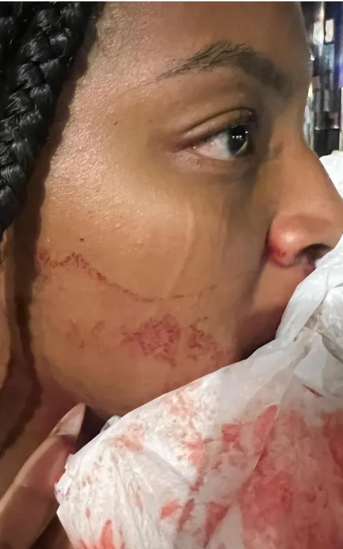 Alessandra Francisco de Souza atingida por um soco, levando 12 pontos na boca