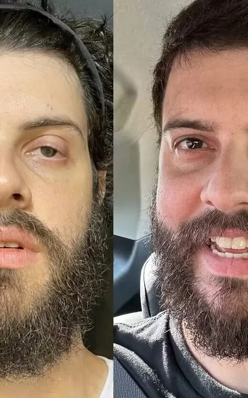 Antes e depois de Diogo Defante após a cirurgia no olho esquerdo