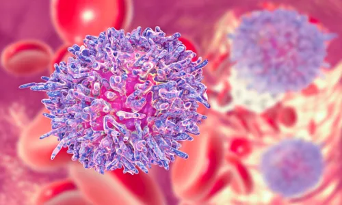 Sintomas da leucemia mieloide aguda podem incluir fadiga, manchas vermelhas nas pernas, sangramento nas gengivas e febre persistente