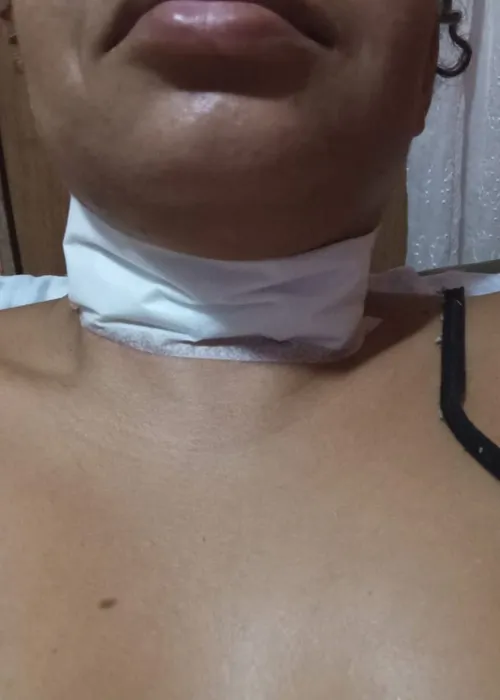 Juliana com curativo no pescoço após sofrer o ferimento
