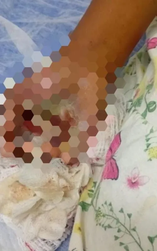 O tratamento deve ser longo e delicado, já que as queimaduras atingiram uma das regiões mais sensíveis do corpo humano
