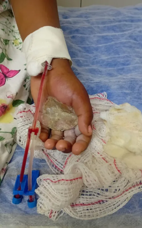 A menina teve queimaduras de terceiro grau nas mãos