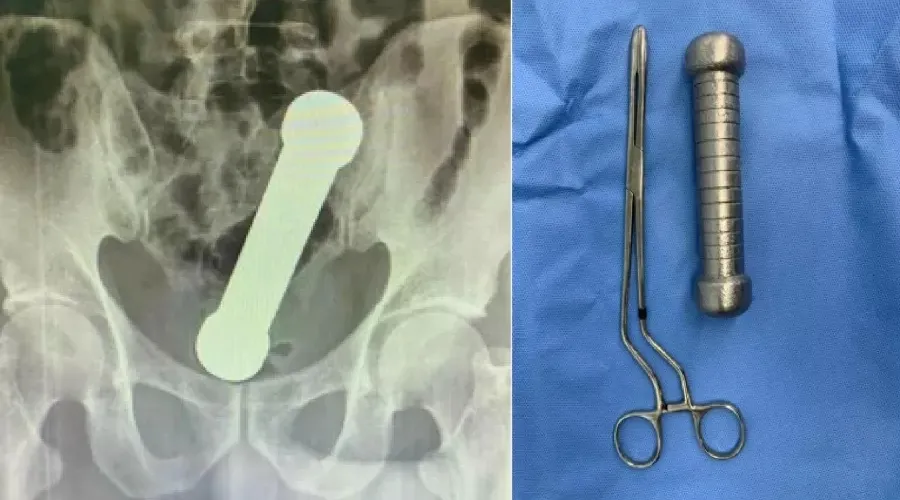 Paciente passou por cirurgia de retirada do objeto em um hospital de Manaus