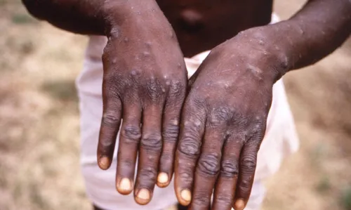 Doença deixa marcas pelo corpo