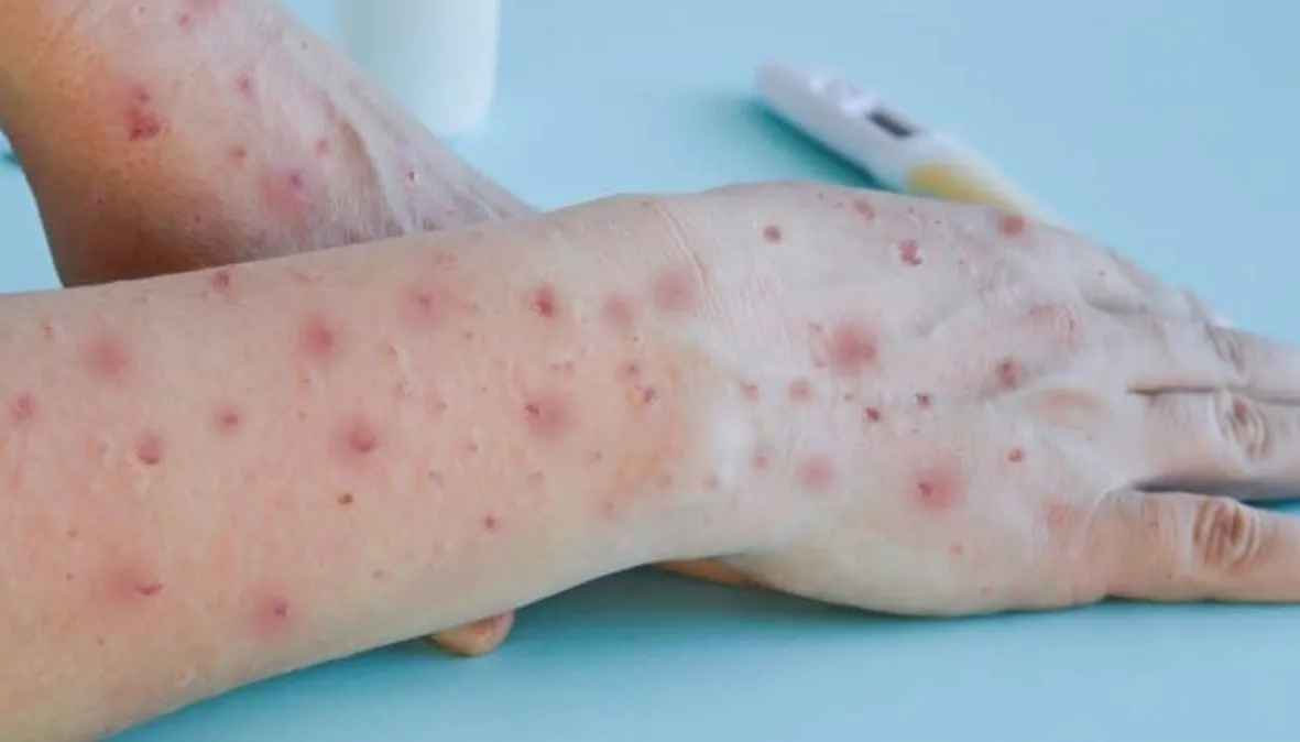 A varíola dos macacos é uma doença causada pela infecção com o vírus Monkeypox