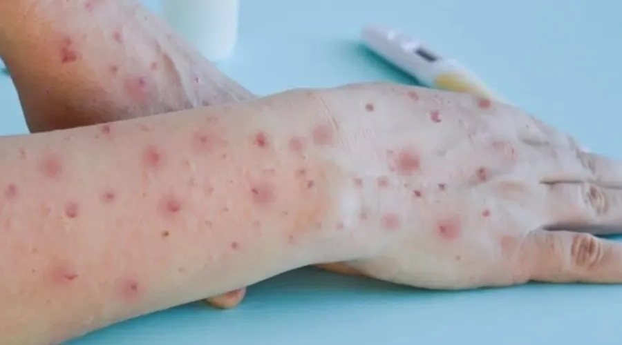 Paciente com varíola dos macacos (monkeypox)