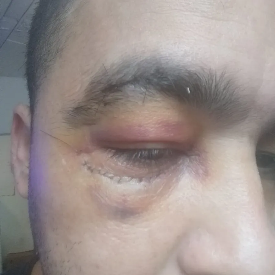 A vítima sofreu lesões no olho esquerdo