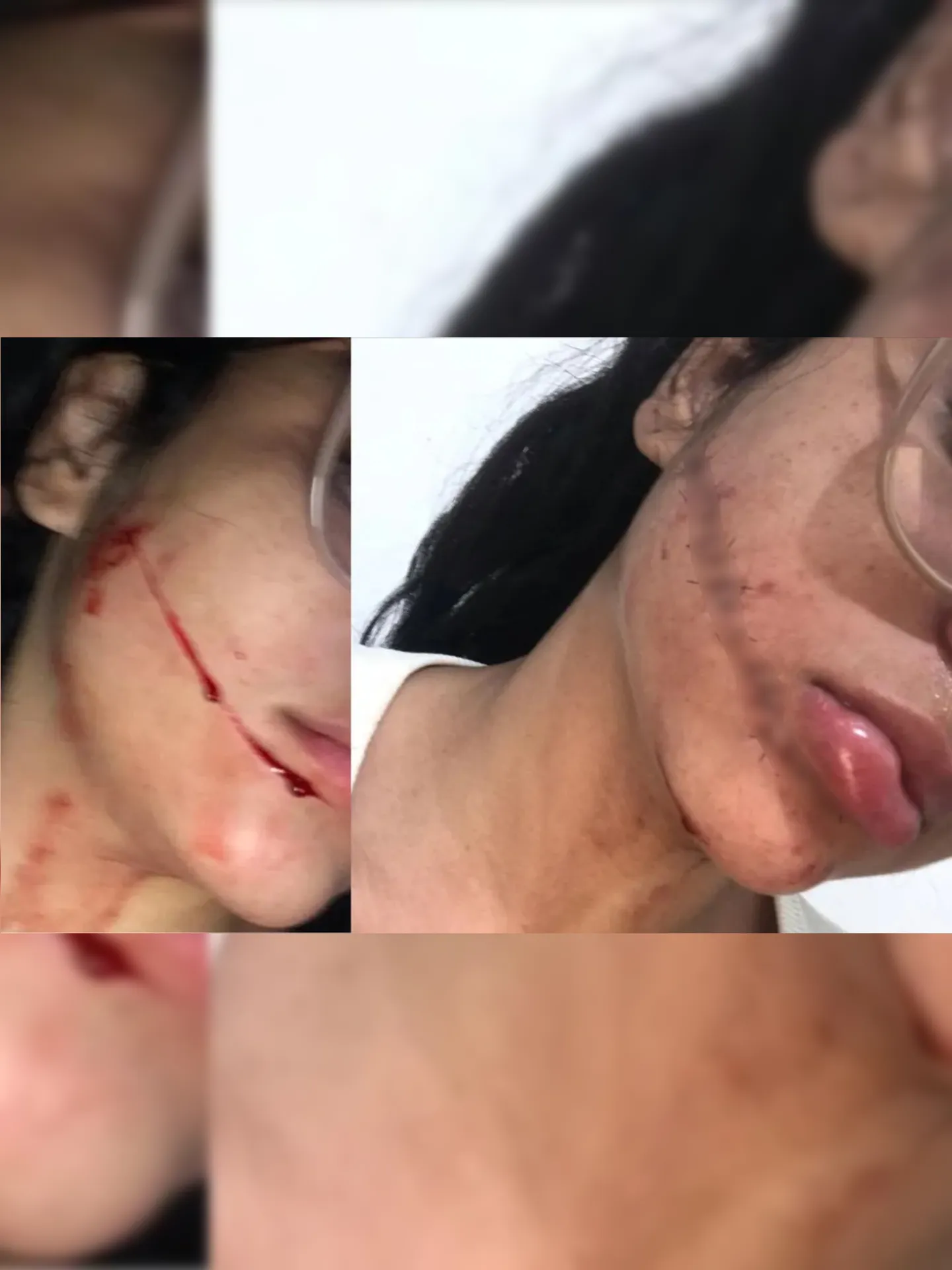 A jovem de 23 anos teve seu rosto cortado durante viagem