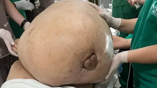 Ela estava com o tumor há cinco anos e seu peso já chegava a 150 kg