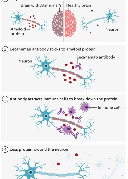 Imagem ilustrativa da imagem Cientistas descobrem medicamento que atrasa avanço do Alzheimer