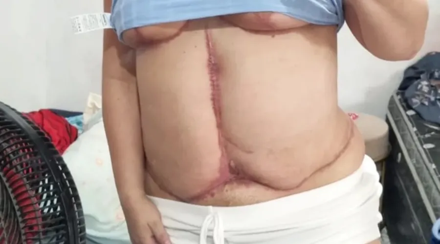 A cirurgia mal-sucedida deixou cicatrizes no corpo da dona de casa