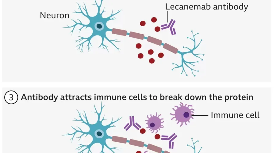 Imagem ilustrativa da imagem Cientistas descobrem medicamento que atrasa avanço do Alzheimer