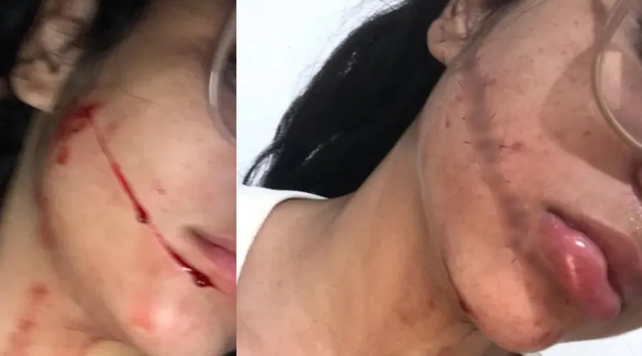 A jovem de 23 anos teve seu rosto cortado durante viagem