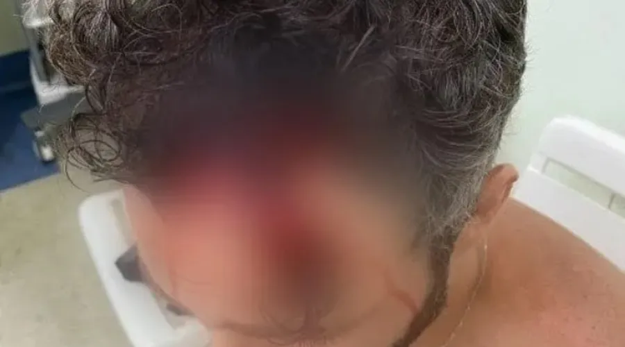 Ator Thiago Rodrigues perdeu parte do couro cabeludo
