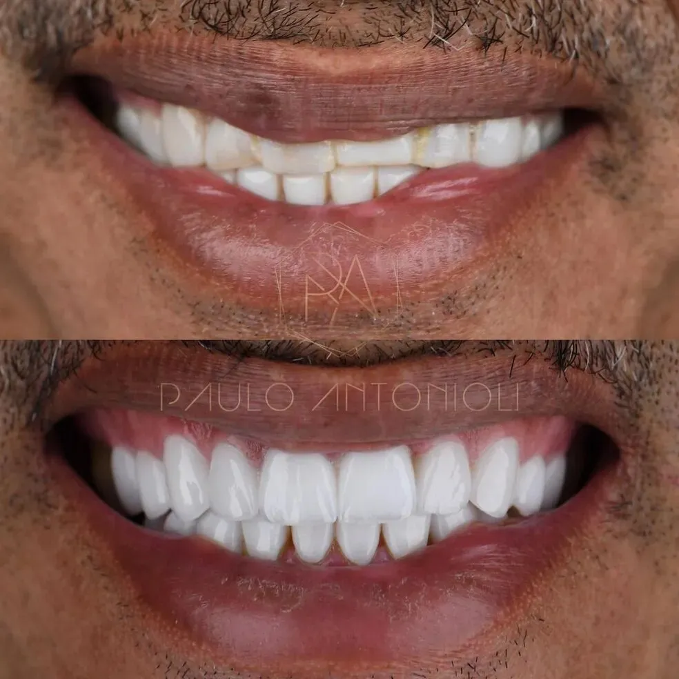Antes e depois do procedimento estético de Manoel Gomes