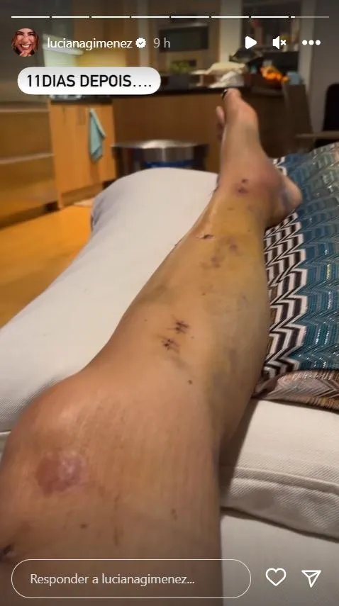 Artista quebrou a perna em quatro lugares
