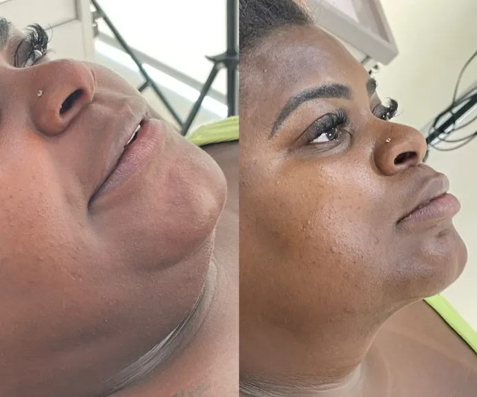 Jojo Todynho realiza procedimento no rosto; veja antes e depois