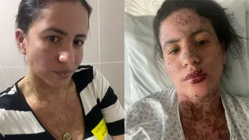 Carol mostrou como seu corpo reagiu após contrair Stevens-Johnson